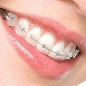 دلایل لق شدن دندان‌ها در ارتودنسی