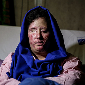جمعه آخرین شانس قربانی اسیدپاشی اصفهان برای بازگشت بینایی‌اش
