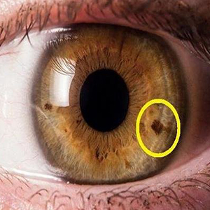 لک های چشم نشانه چیست؟