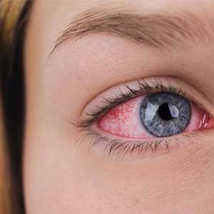 استفاده از معده خوک برای درمان خشکی چشم