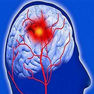 آشنایی با فاکتورهای پرخطر احتمال خونریزی در بازماندگان سکته مغزی