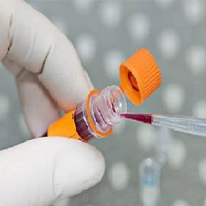 تشخیص سرطان سینوس با آزمایش خون