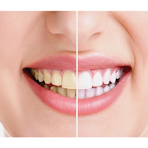 سفید کردن دندان با مواد شیمیایی خانگی ممنوع