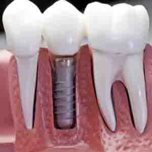 باید‌ها و نباید‌های کاشت دندان