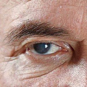 بیماریهای موذی چشمی که ۸۰ درصد مردم از آنها اطلاع ندارند