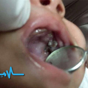 عکس/۷ دندان نوزاد یکماهه با عمل جراحی خارج شد!