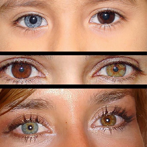 چرا رنگ 2 چشم برخی از افراد متفاوت است؟