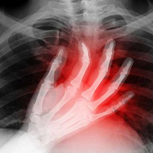 10 درصد موارد درد قفسه سینه کودکان مربوط به مسائل قلبی است