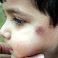 پاییز و زخم سالک بر چهره کودکان فارس