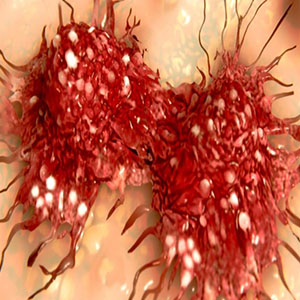ویروسی هولناک که سرطان رحم را به جان زنان می اندازد