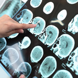 درمان تومور مغزی با تجهیزات نوین در شمال شرق کشور میسر شد