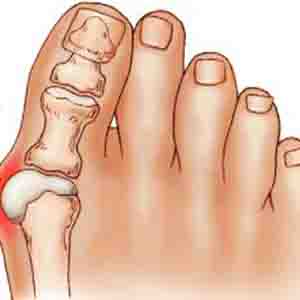 چگونه عارضه التهاب مفصل انگشت پا را درمان کنیم؟
