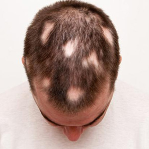 علل ریزش سکه‌ای "مو" چیست؟