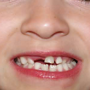 سه راه برای کنترل پوسیدگی دندان کودکان