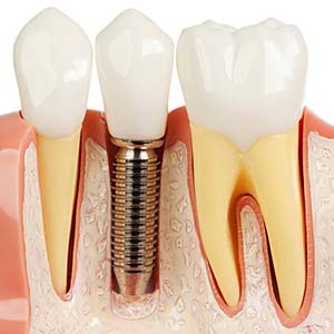 افزایش طول عمر ایمپلنت‌های استخوانی و دندانی