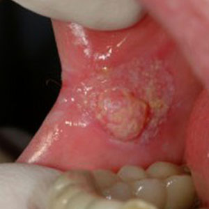 شایع‌ترین علل بروز کیست‌ و تومور در دهان