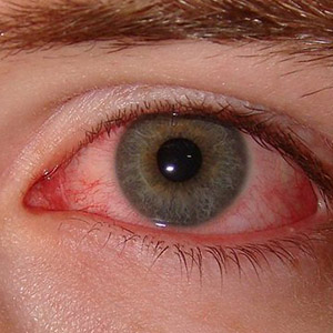 لکه های قرمز داخل چشم چه پیام هایی درباره سلامتی شما دارند؟