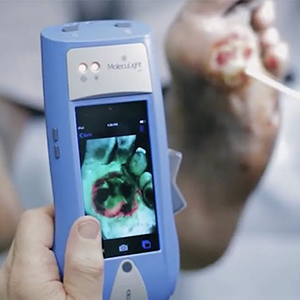 ابداع دستگاهی با قابلیت نمایش باکتری‌های موجود روی زخم