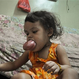 تومور عجیب در دهان دختر فیلیپینی+تصاویر