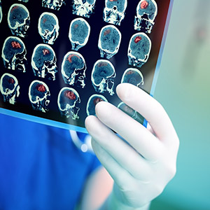 کاهش سرعت رشد تومور بدخیم مغز با استفاده از ابزار الکتریکی