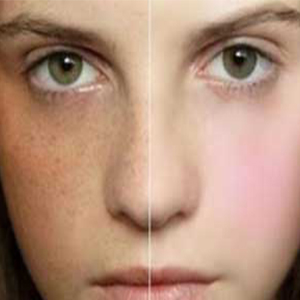 روش‌های کاهش لک‌های پوستی