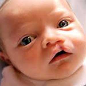 احتمال تولد نوزادان مبتلا به شکاف دهانی با مصرف داروی ضد صرع در دوران بارداری