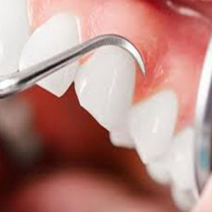درمان ریشه دندان از عفونت‌های مزمن جلوگیری می‌کند