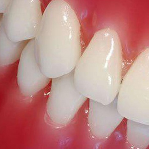 نقش بزاق دهان در جرم سازی دندان/ خون‌ریزی لثه نشانه چیست؟