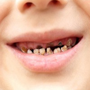 آمار بالای خرابی دندان های شیری کودکان ایرانی