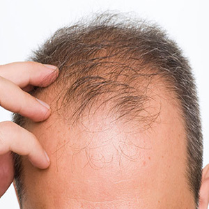 ریزش مجدد موی کاشته شده با اختلالات تیروئیدی