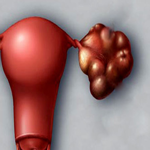 ضرورت پیشگیری و درمان سندرم تخمدان پلی کیستیک از دوران بلوغ