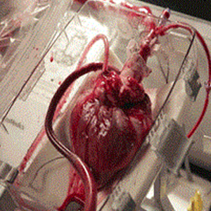 کاهش بیماران نیازمند پیوند قلب با حمایت بیمه‌ها