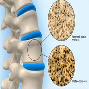 افزایش موفقیت در درمان استخوان مرمری با سلول های بنیادی