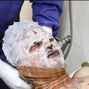 بیشترین آسیب های حوادث چهارشنبه سوری/ وضعیت تخت های سوختگی