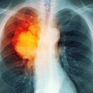 رتبه برتر ایران در تشخیص و درمان سرطان ریه