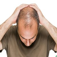 فرم شدید ریزش مو در مردان شایع تر است