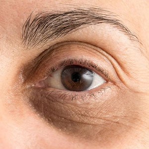 روش‌هایی ساده برای بهبود حلقه‌های تیره زیر چشم