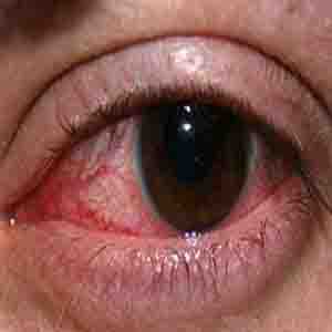 آنچه در مورد آلرژی‌های چشمی باید بدانید