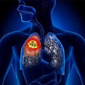داروی امیدبخش برای درمان سرطان ریه