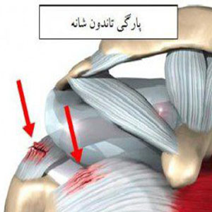 علل پارگی تاندون شانه/ موفقیت ۹۵ درصدی جراحی های شانه در ایران