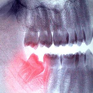 چند توصیه برای تسریع بهبودی پس از جراحی دندان عقل