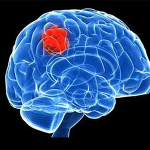 5 نشانه تومور مغزی که نباید نادیده گرفته شوند