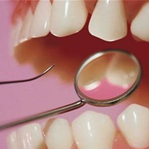 ایرانی ها ۳۰۰ میلیون دندان پوسیده دارند/شایع ترین بیماری عفونی