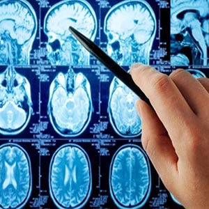 واکسن سرطان مغز طول عمر بیماران را افزایش می دهد