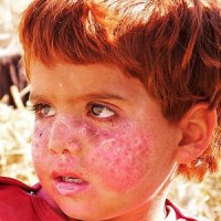 زخم خشکسالی بر رخ تب دار کودکان