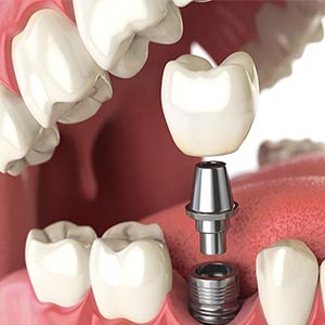 آنچه در مورد ایمپلنت‌های دندانی باید بدانید