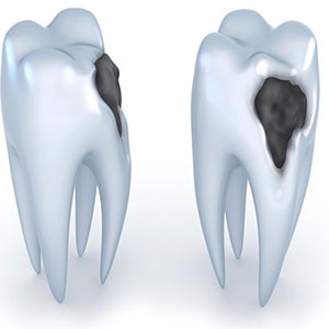 ابداع روشی برای بازسازی مینای دندان
