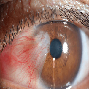 بی‌توجهی به درمان تبخال چشمی موجب کاهش بینایی می‌شود