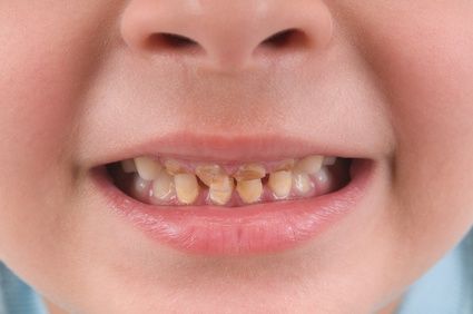 قطره آهن موجب پوسیدگی دندان کودکان نمی‌شود