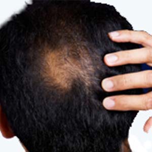 درمان ریزش مو با از کار انداختن یک ژن